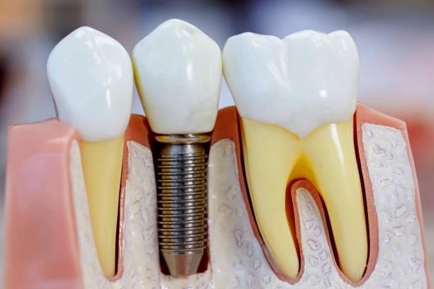 dental implant in osseo