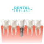 Are You a Candidate for Dental Implants? Key Factors to Consider