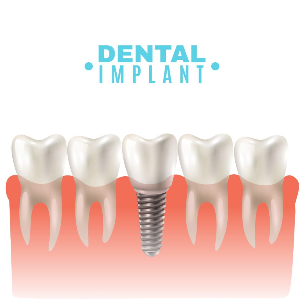 dental implants norwood