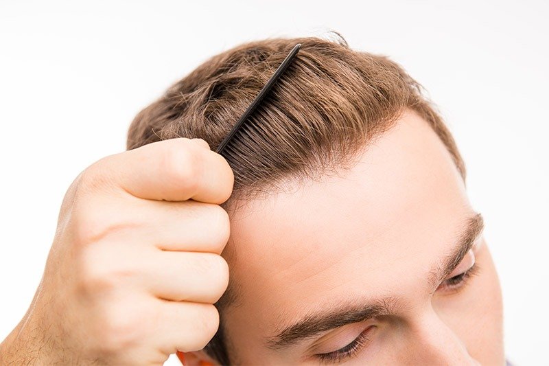 How Many Grafts Do You Need for a Hair Transplant