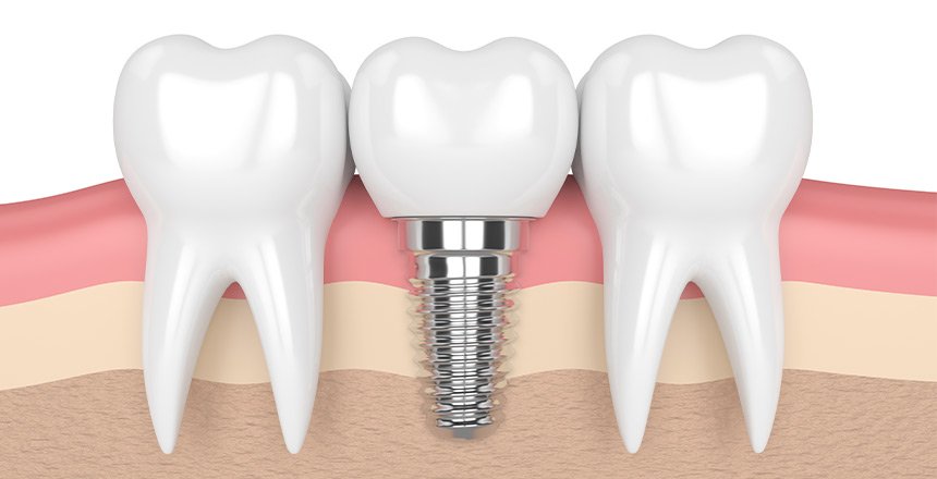 tooth replacement