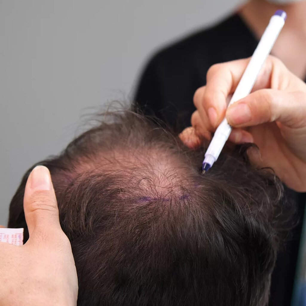 Hair Transplant in Dubai