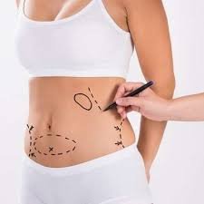 Liposuction Surgery in Riyadh