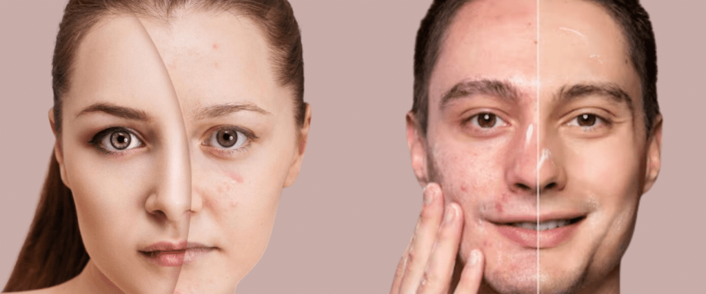 Acne Treatment in Mira Bhayandar