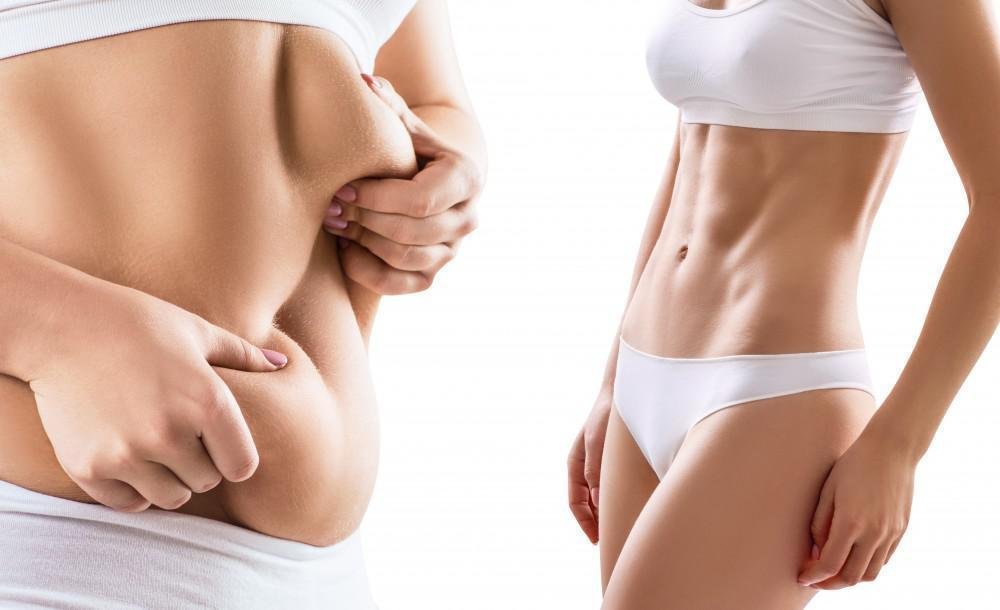 Liposuction in Dubai