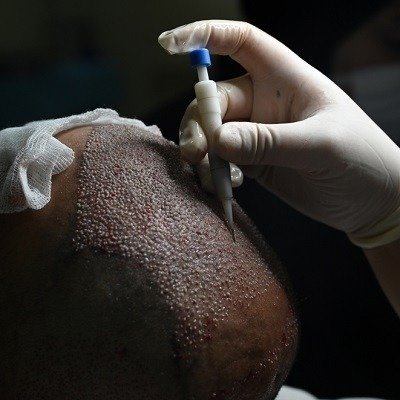 Hair Transplant in Islamabad