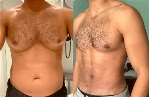 Gynecomastia in Dubai