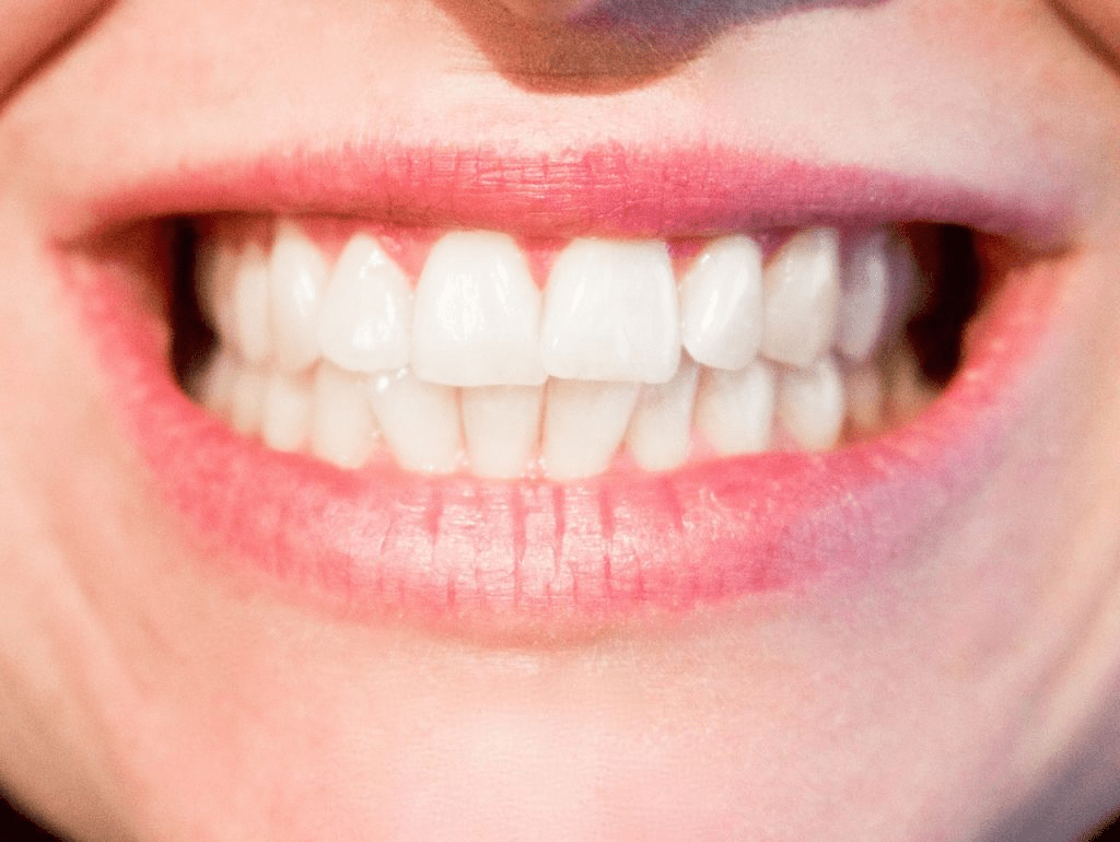 Teeth Whitening for Sensitive Teeth Achieving a Radiant Smile