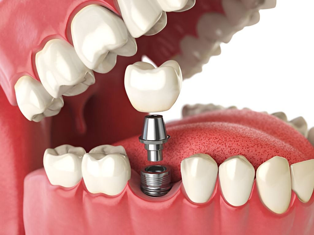 dental implants ottawa