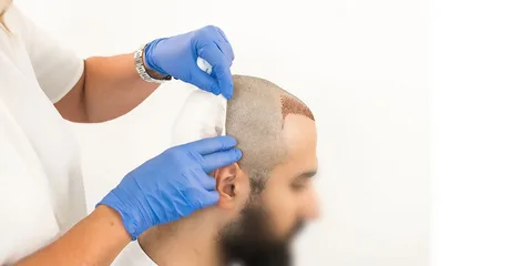 Hair Transplant in Dubai