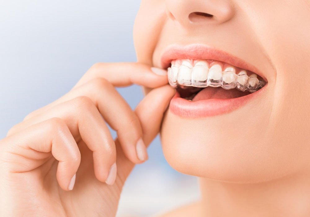 Everything You Need to Know About Invisalign Treatment