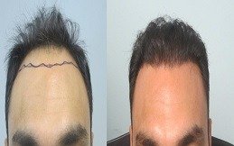 زراعة الشعر في دبي