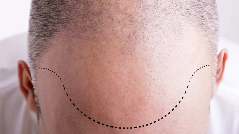 Hair transplant in Dubai