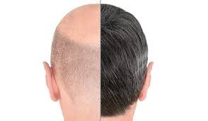 Hair Transplant in Dubai