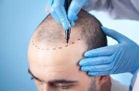 How Long Does It Take to See Results from a Hair Transplant