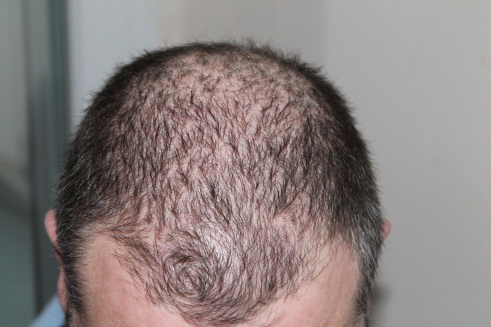 What Are the Pros and Cons of Hair Transplants