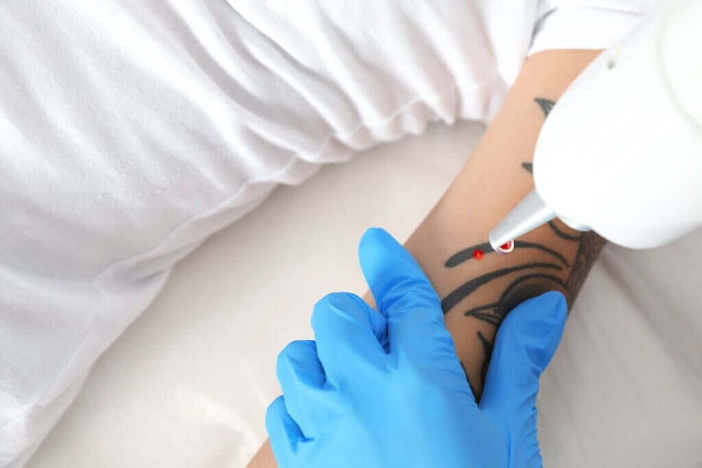 Top Three Lasers for Tattoo Removal: A Comprehensive Guide