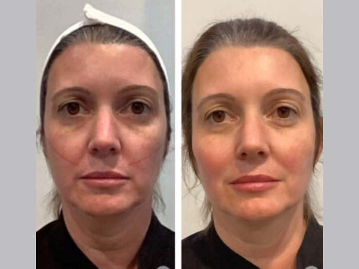 Best Doctors in Dubai: Renowned Thread Lift Experts Trusted by Celebrities