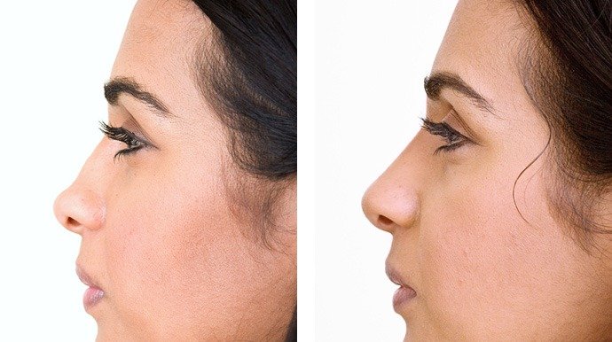 Rhinoplasty in Dubai