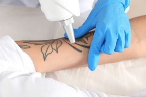 Is Laser Tattoo Removal Safe for Everyone? A Comprehensive Guide