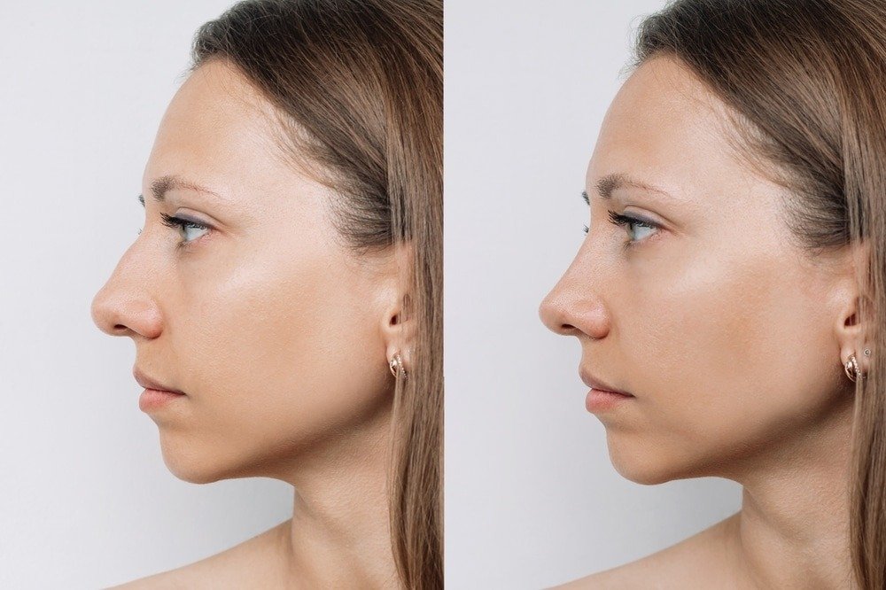 Rhinoplasty in Dubai