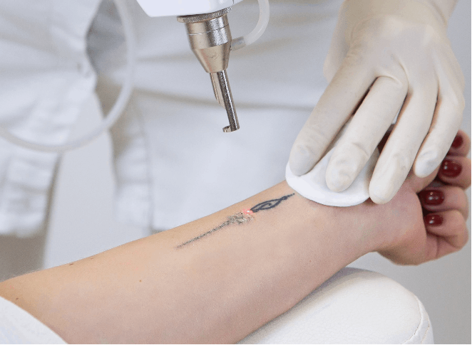 Tattoo Removal in Dubai