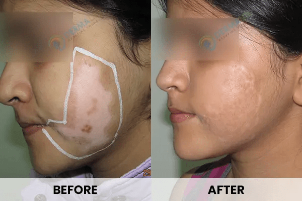 Vitiligo Treatment Before After