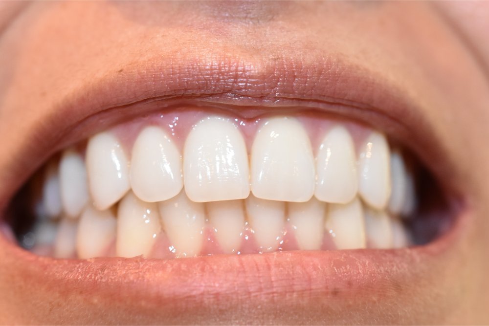 Aesthetic Dental Restorations for a Perfect Smile