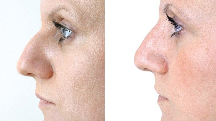 Rhinoplasty in Dubai