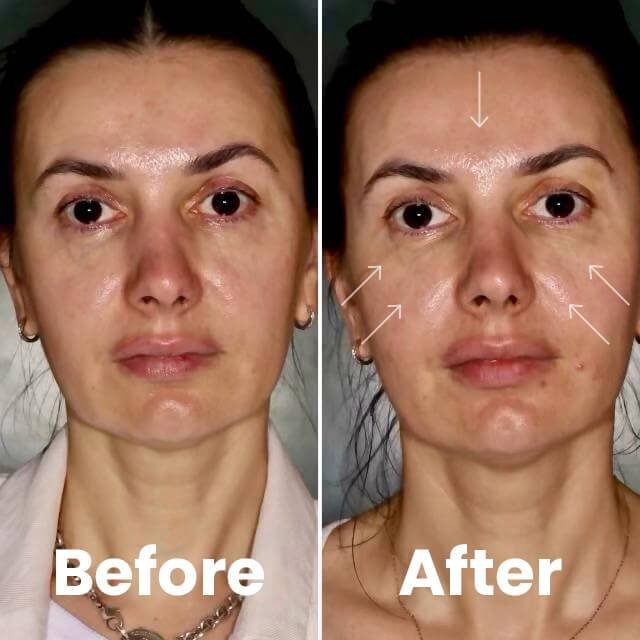 skinvine treatment by Embrace skin