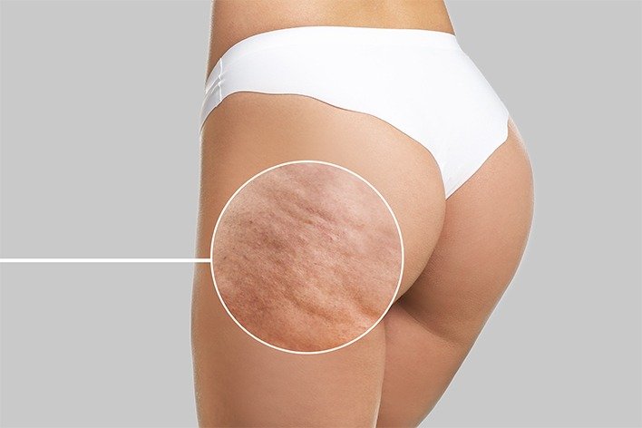 Lipotropic injections in Dubai