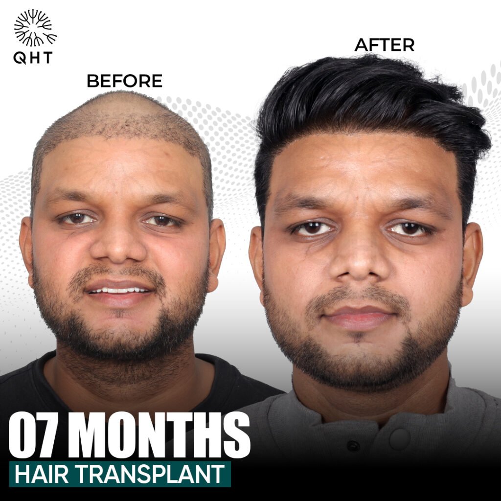 FUE hair transplant