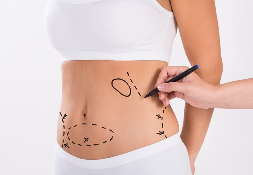 abdominoplasty Dubai