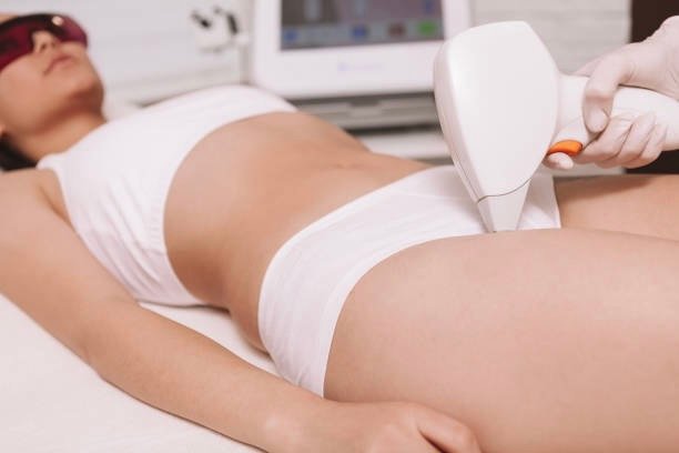 Does laser remove hair permanently?