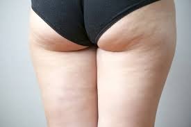 Cellulite Treatment in Dubai