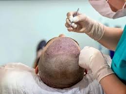 hair transplants