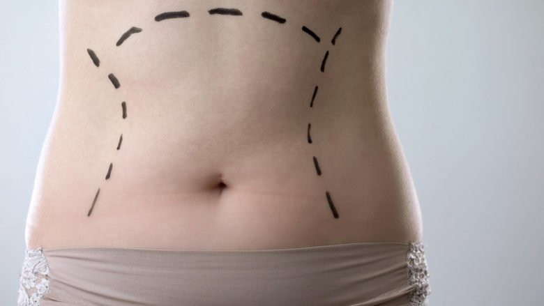 mini abdominoplasty