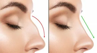 جراحة تجميل الأنف في الرياض