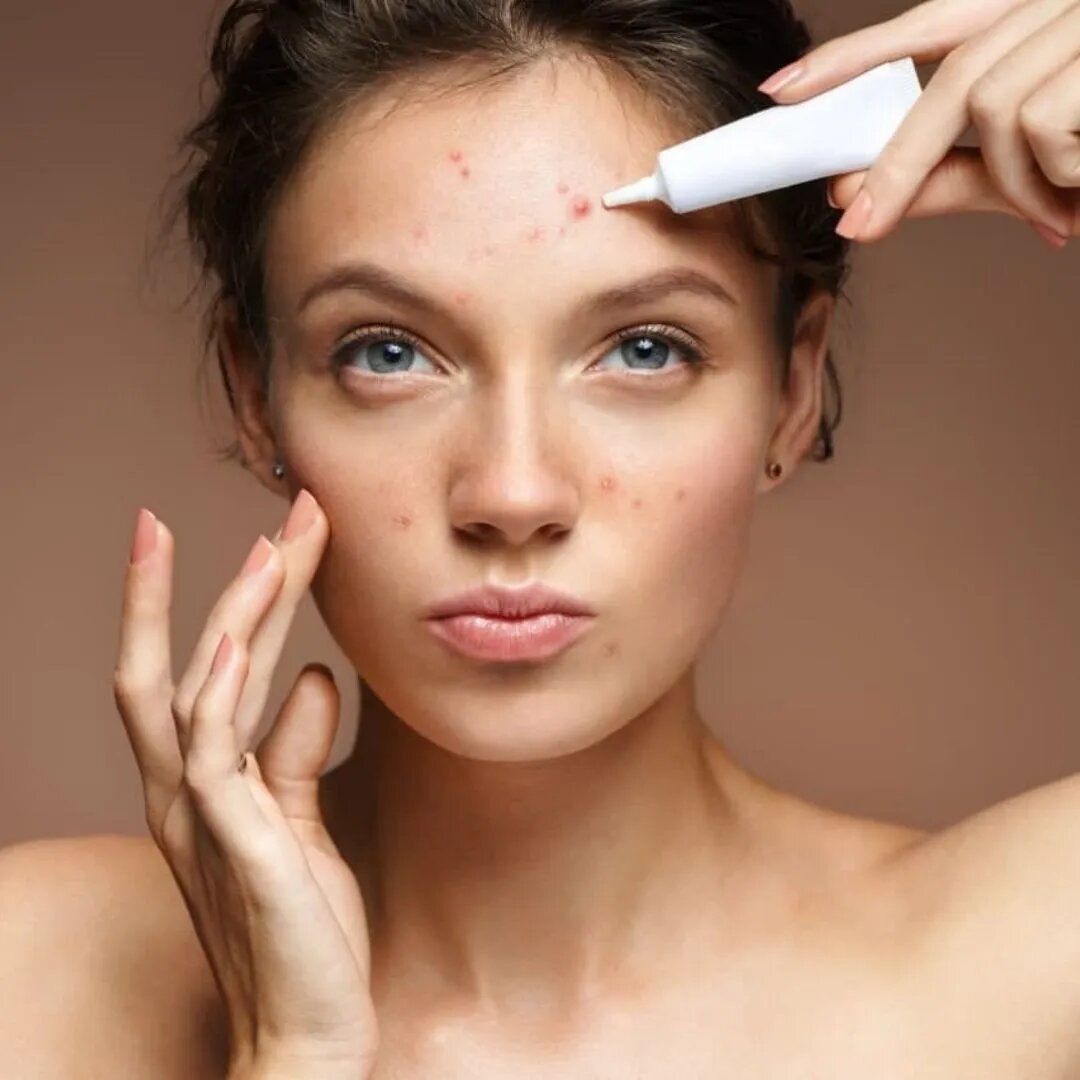 Acne Treatment Dubai