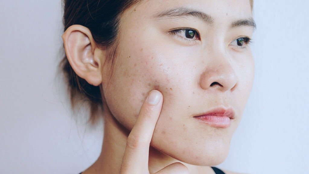 Acne Treatment Dubai