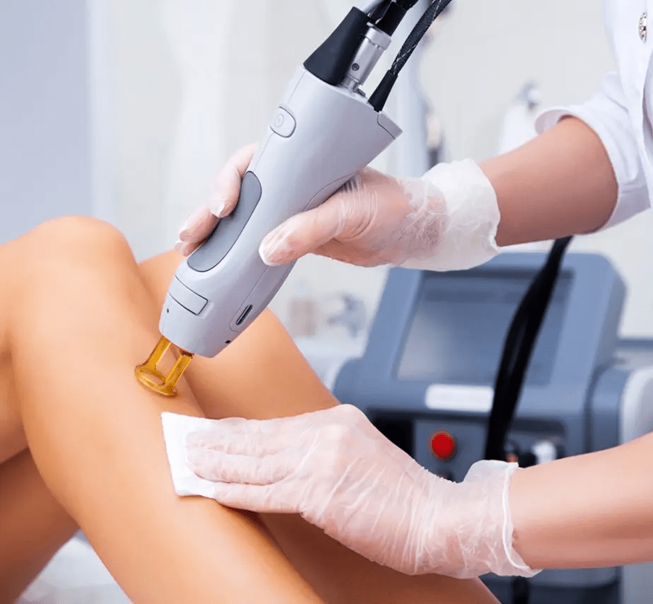 Can Laser Hair Removal Help With Strawberry Legs?