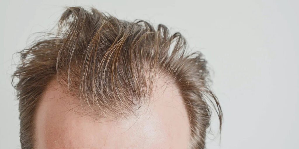 Does Finasteride for Hair Loss Work on Crown