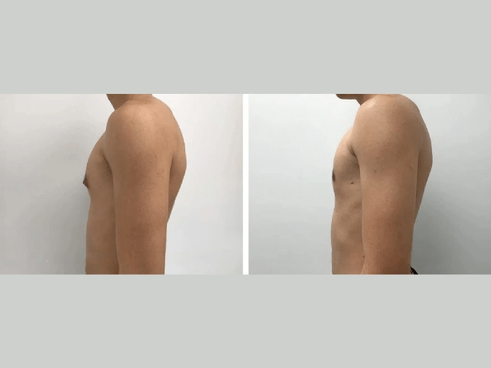 gynecomastia of male