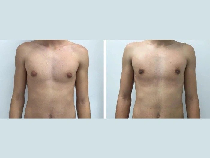 Gynecomastia in dubai