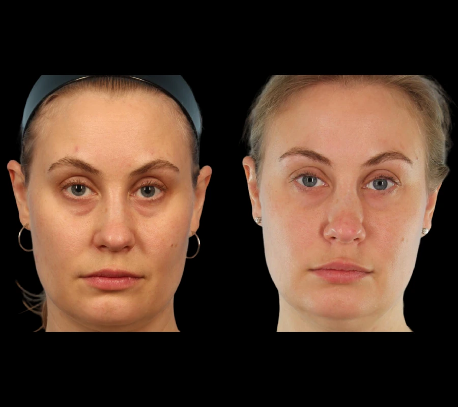Under-eye-fillers
