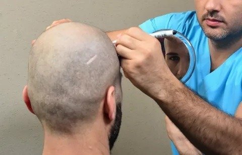 Hair Transplant in Dubai