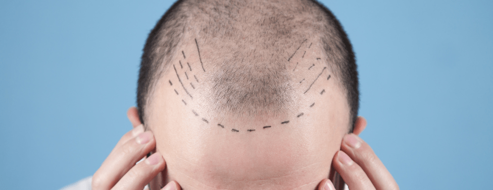 Hair Transplant in Dubai