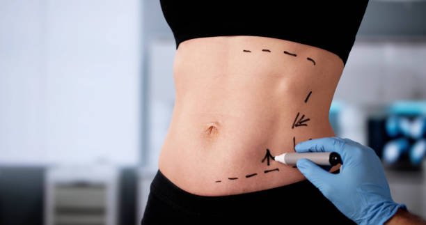 How Long Do LiposuctionResults Last