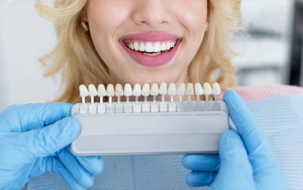How Long Do Tooth-Colored Fillings Really Last?