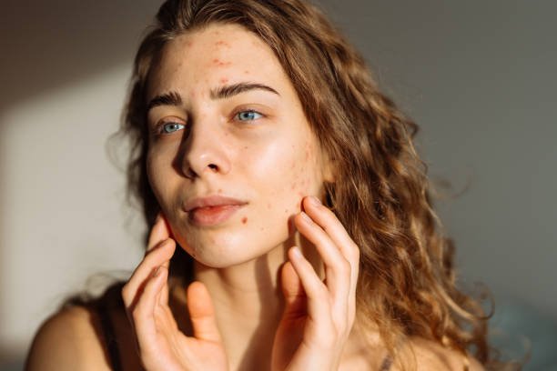 How Long Does Laser Acne Scar Treatment Last